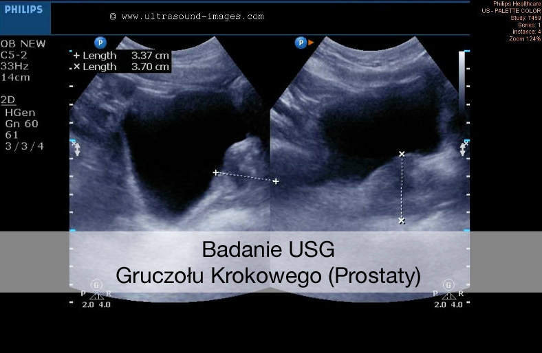 Badanie USG Gruczołu Krokowego (Prostaty)
