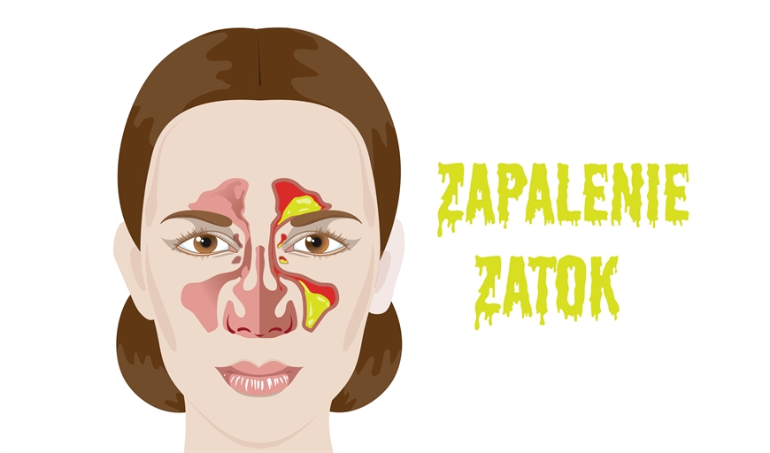 ZAPALENIE ZATOK • OBJAWY I LECZENIE
