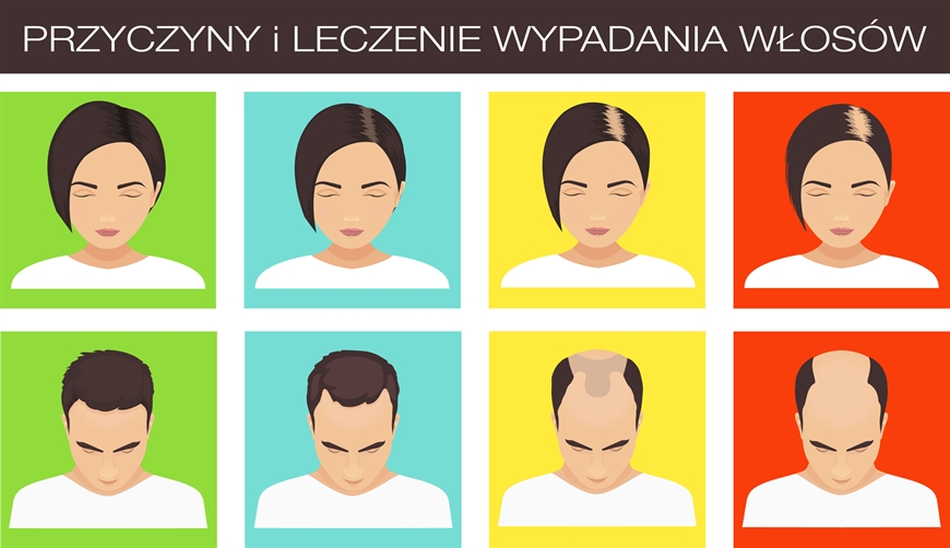 Leczenie wypadania włosów osoczem bogatopłytkowym